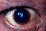 Cataract Photos