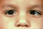 Pediatrics and Strabismus Photos